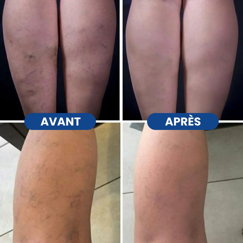 Avant / Après varices