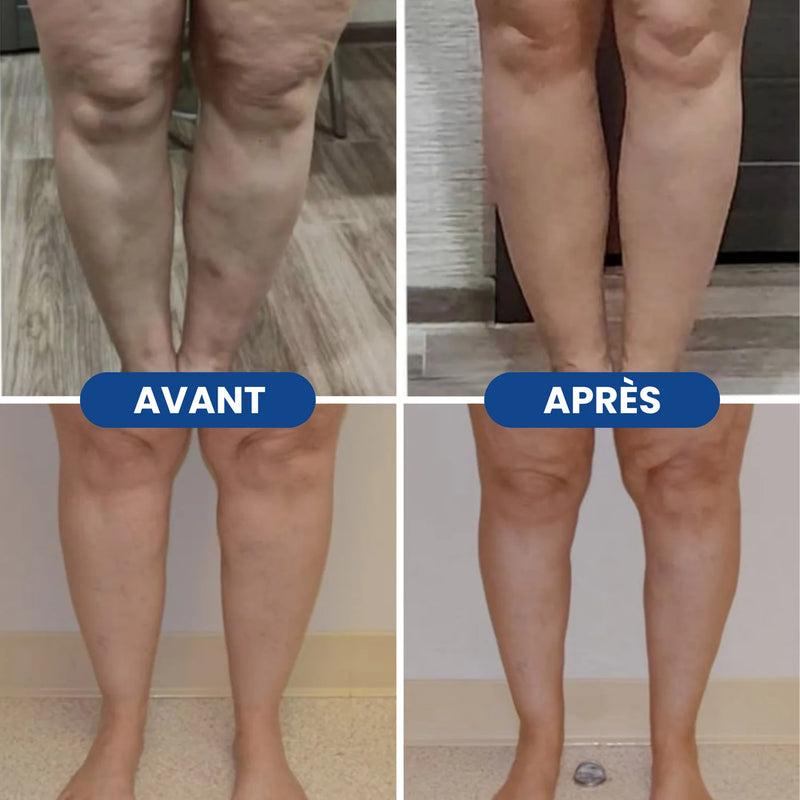 Avant / Après jambes lourdes